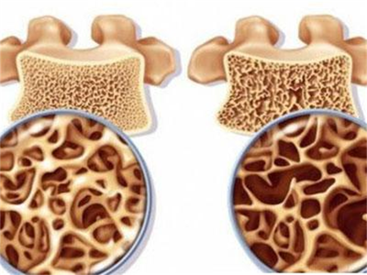 骨質(zhì)疏松癥，你真的了解嗎？